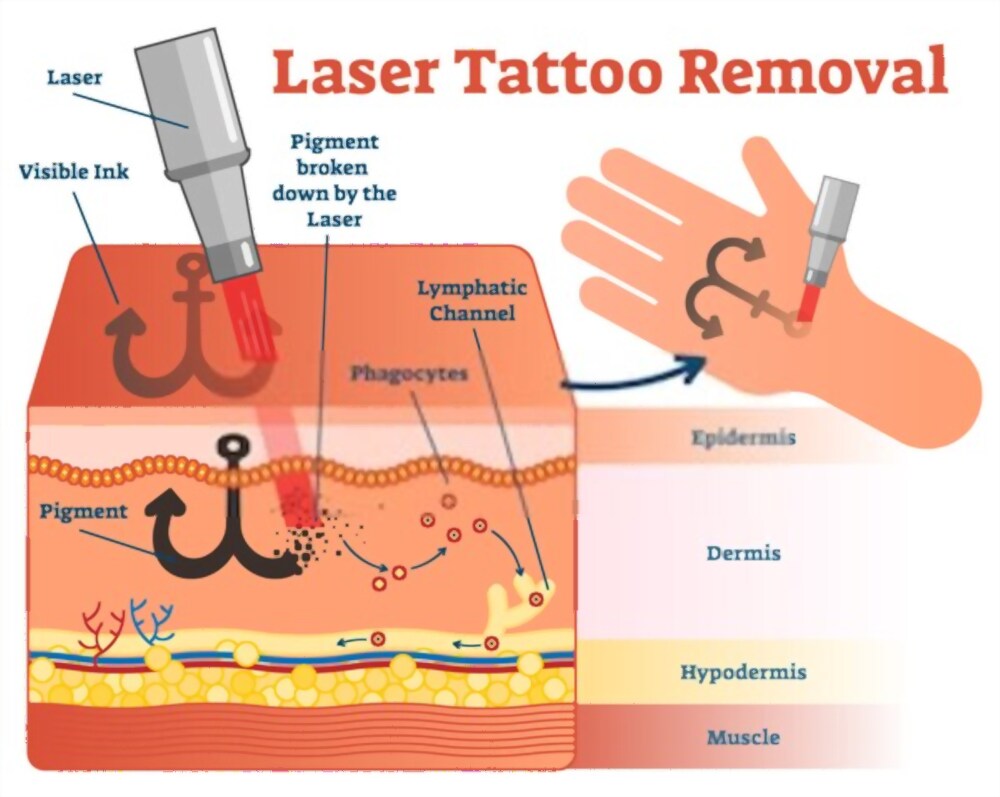 Laser tattoo removal details