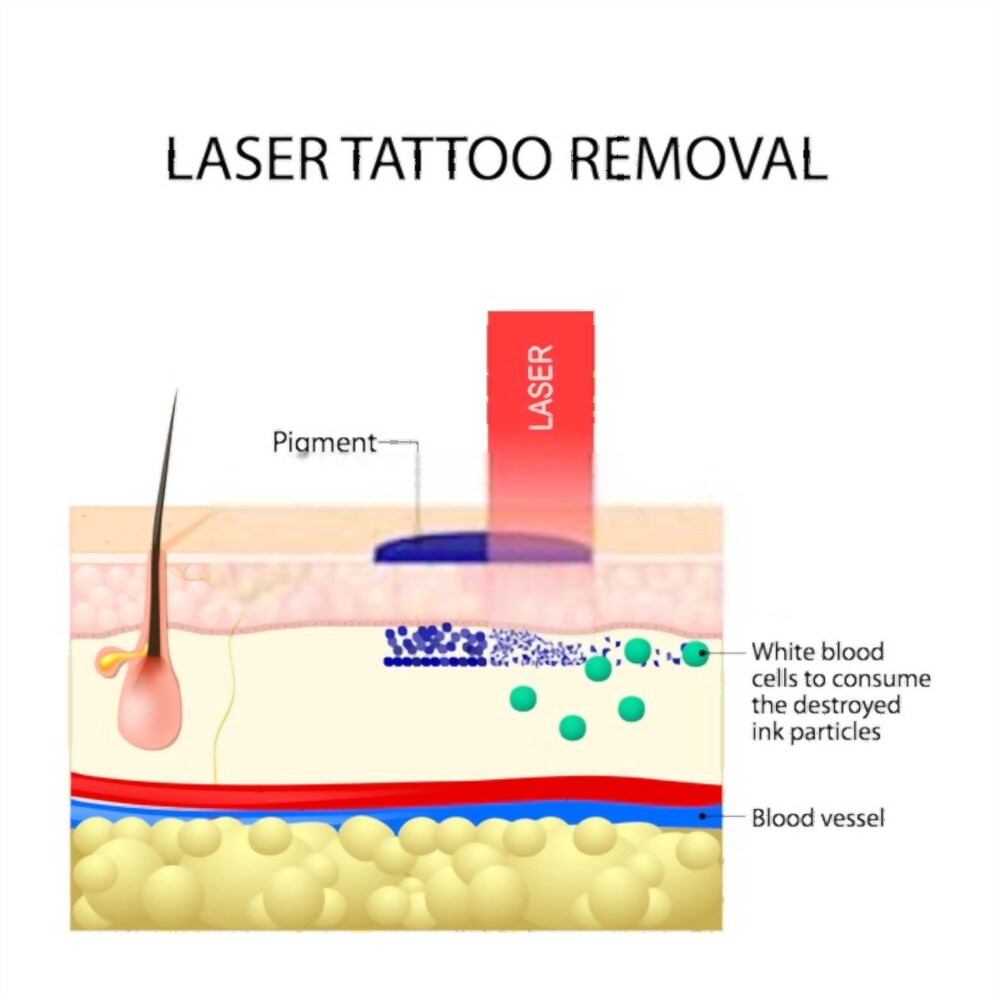 how laser tattoo removal works