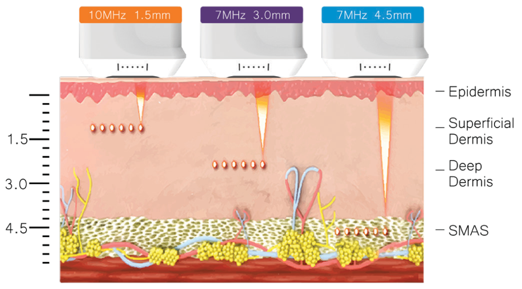 HIFU face and body treatment