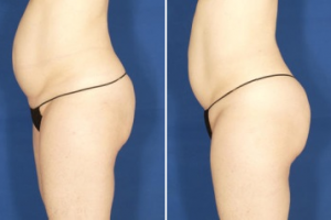 Radiofrequency treatment